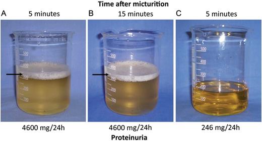 Proteinuria orina